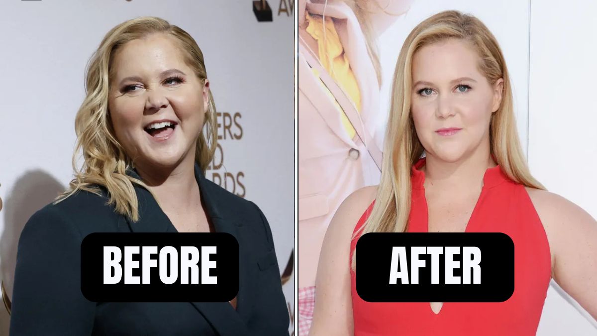 Amy Schumer’s Weight Loss Journey- How She Lost 30 lbs On Ozempic but Quit Due To Severe Side Effects